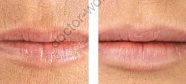 Как сделать губы пухлыми в домашних условиях - 12 народных средств увеличения губ