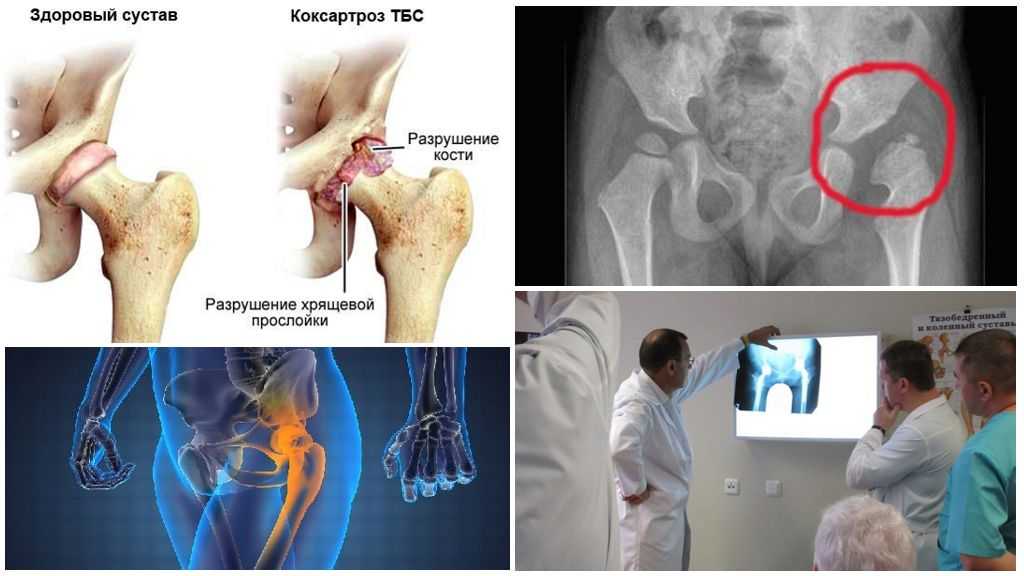 Тотальное эндопротезирование тазобедренного сустава | kinesiopro