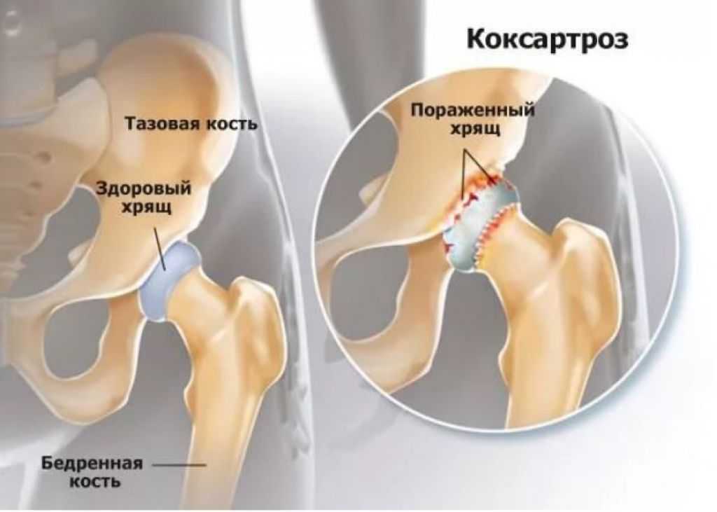 Лечение артроза тазобедренного сустава ortoped-klinik.com