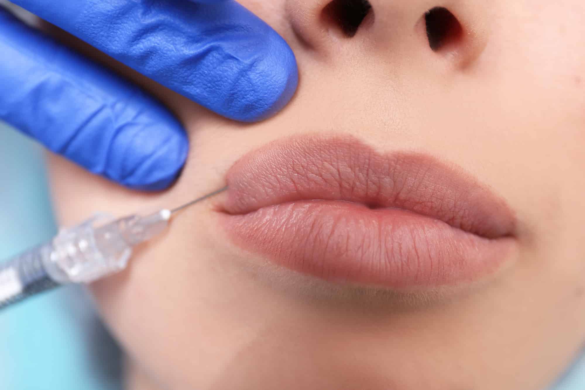 Способы выведения гиалуроновой кислоты из губ