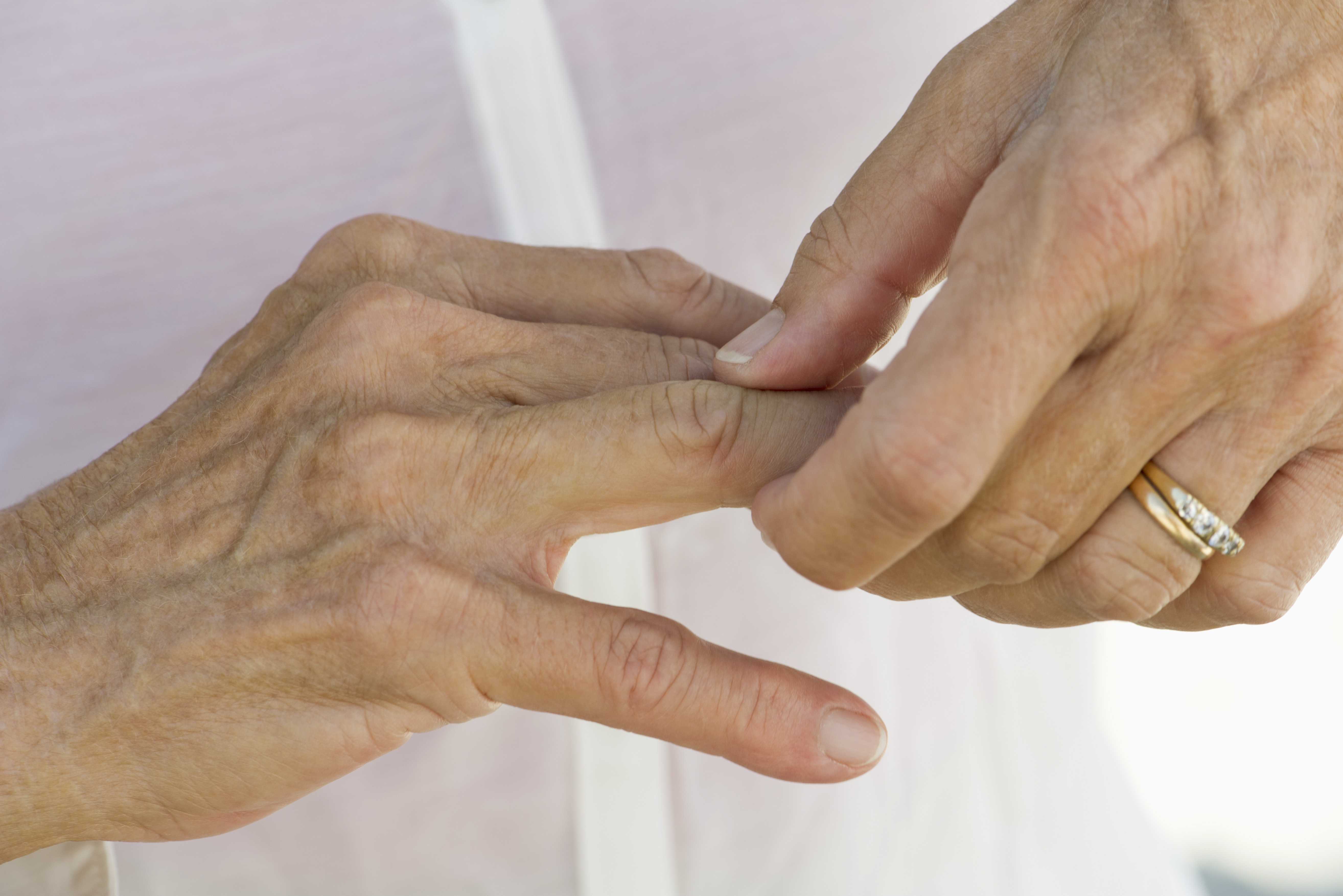 Ревматоидный артрит суставов кистей. Скованность суставов пальцев рук.